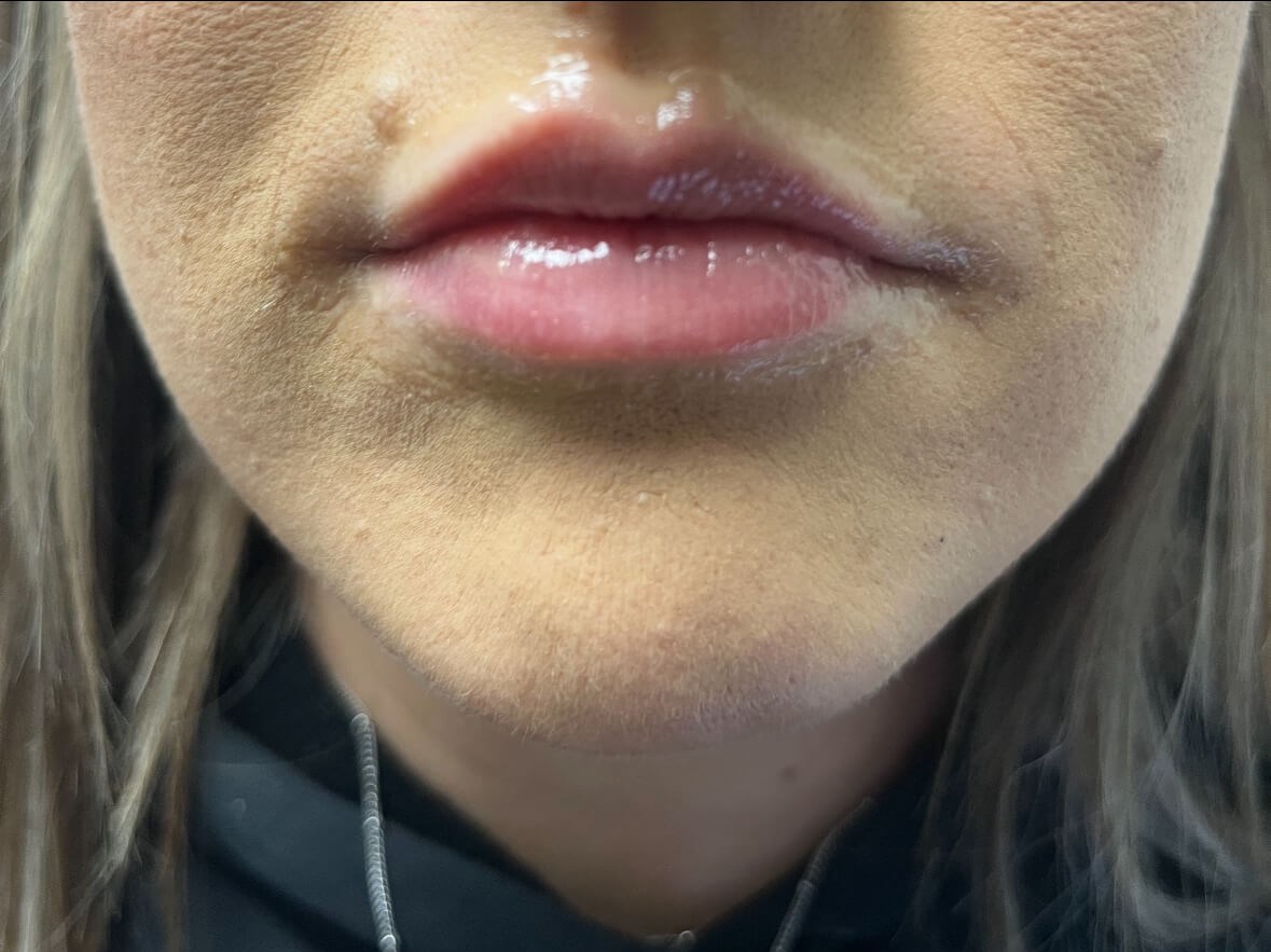 Lip Filler Juvederm Ultra XC Before