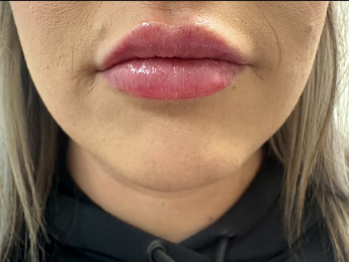 Lip Filler Juvederm Ultra XC After