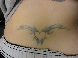 Tattoo removal in Hurst Texas Before