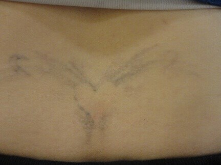 Tattoo removal in Hurst Texas After 4 treatments