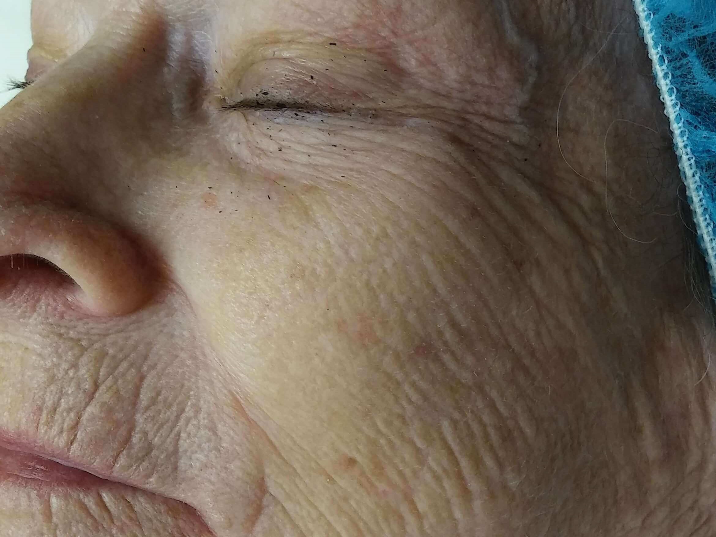 Hydrafacial MD Before