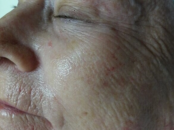 Hydrafacial MD After