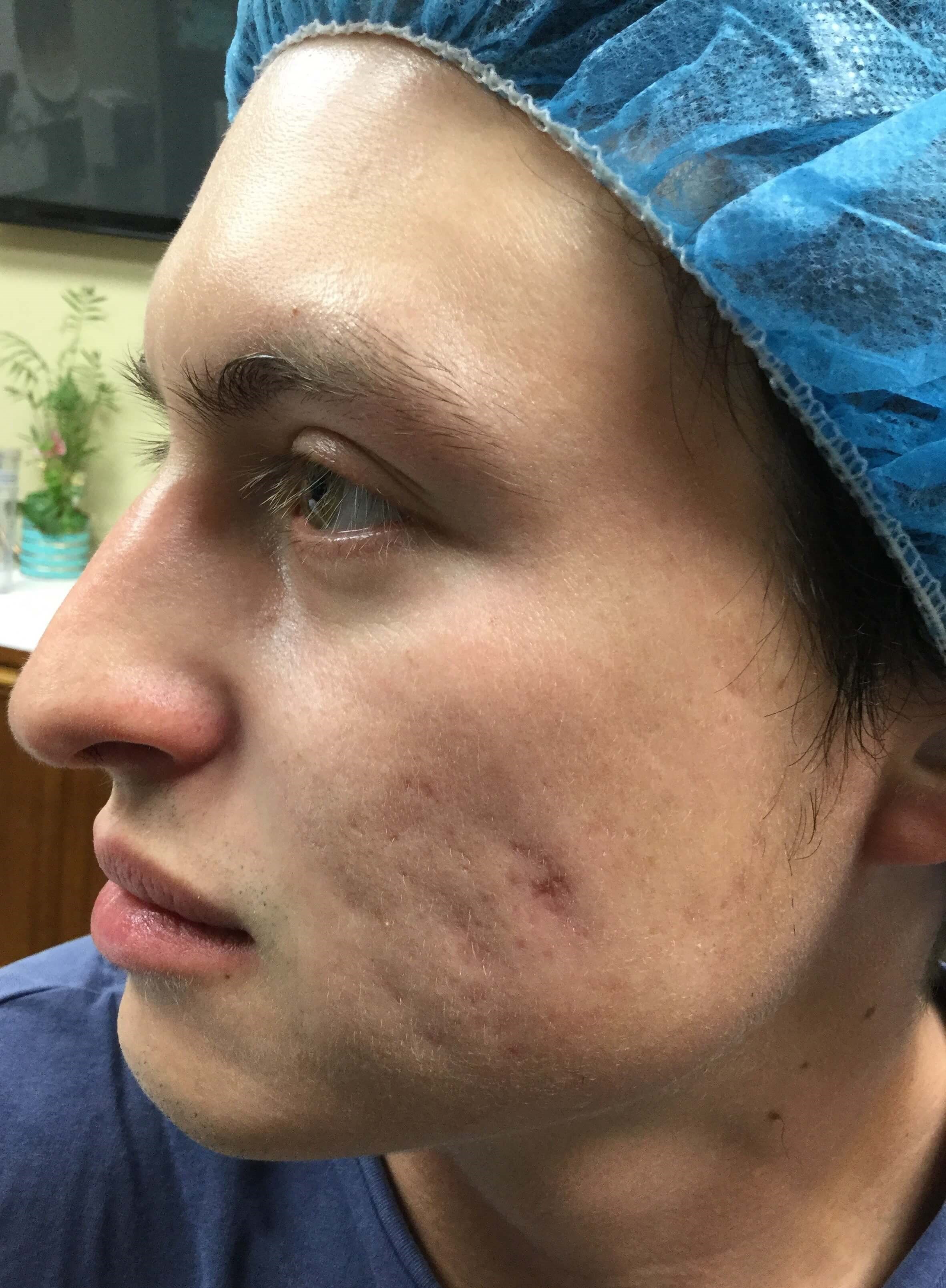 Skinpen Microneedling Before