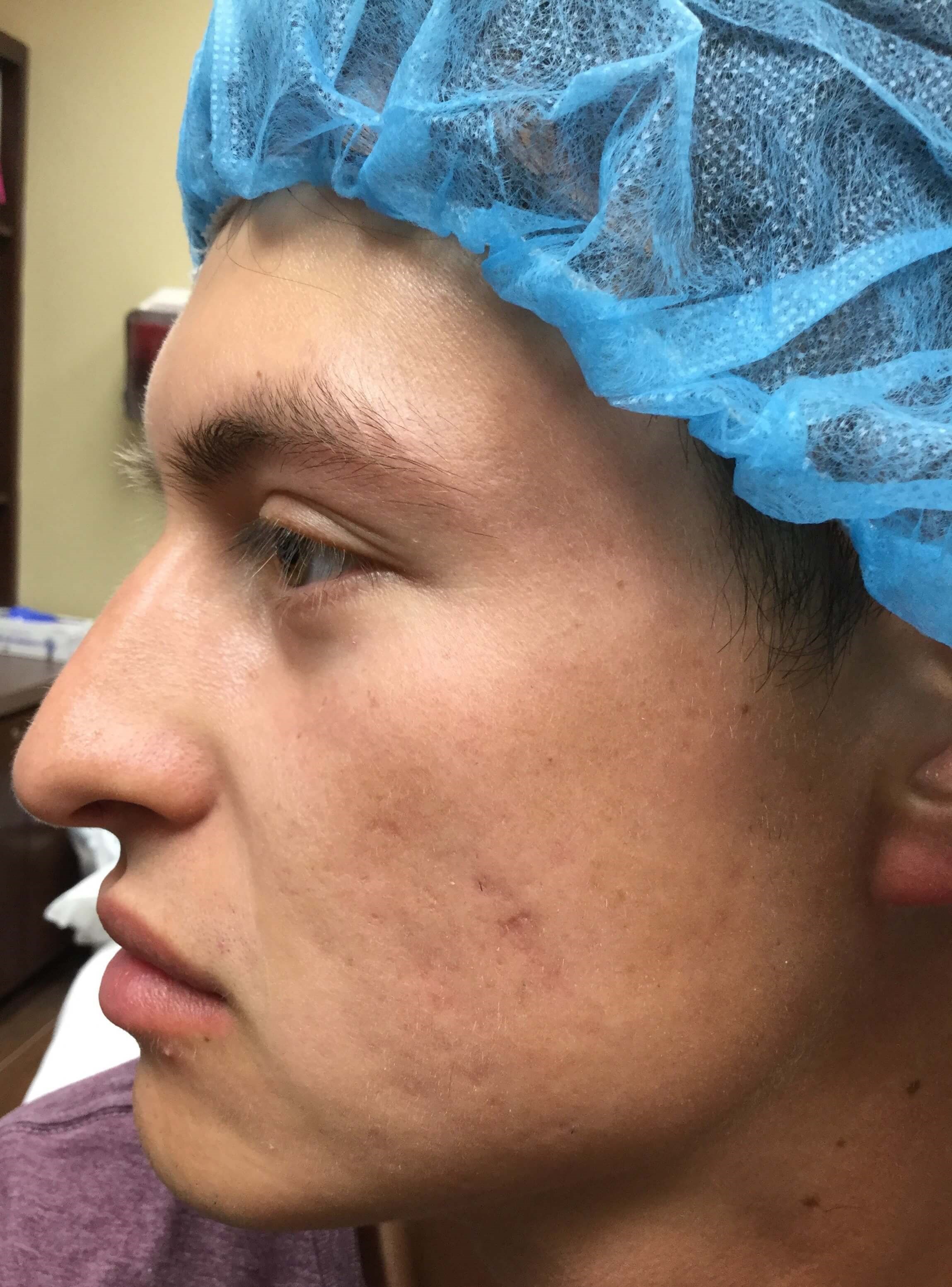 Skinpen Microneedling After 2 treatments