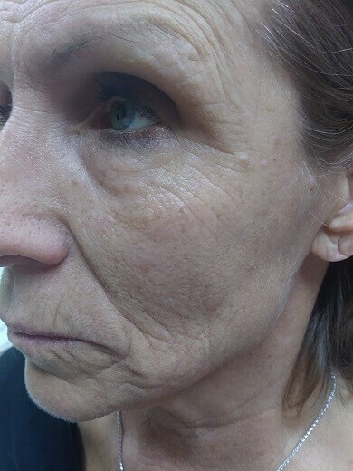 Hydrafacial MD Before