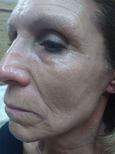 Hydrafacial MD After Hydrafacial