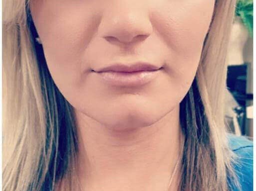 Lip enhancement with Juvederm After