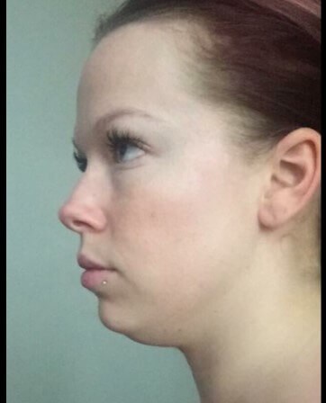 Kybella for submental fat! Before