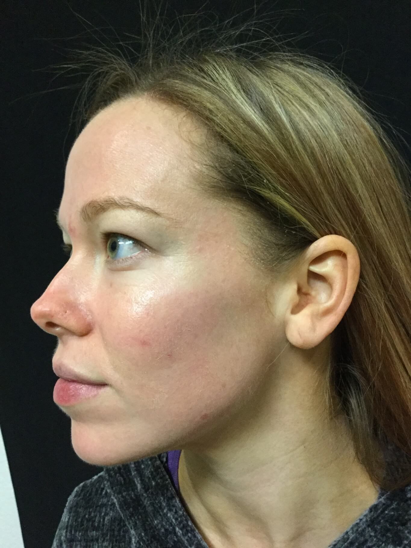 Kybella for submental fat! After