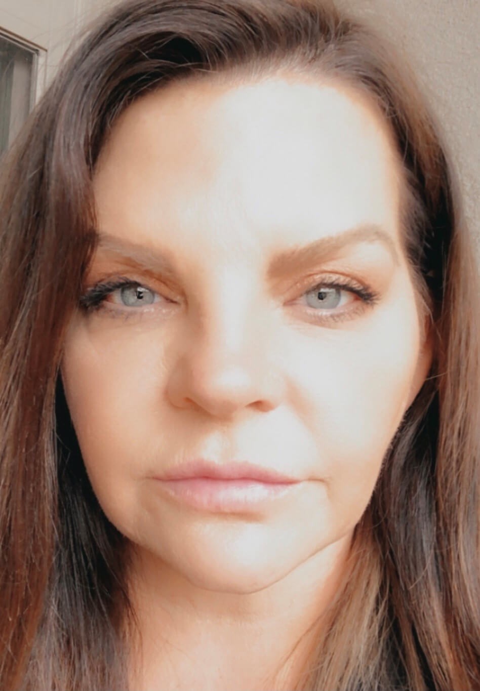 Cheek and chin enhancement Before